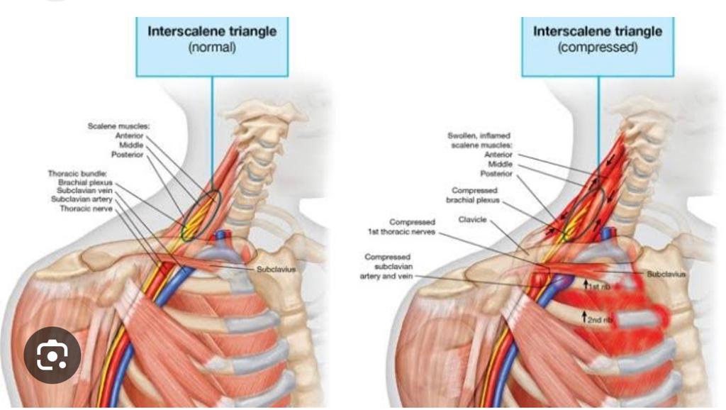 متلازمة مخرج الصدر: الأسباب والأعراض وطرق العلاج